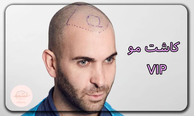 کاشت مو VIP