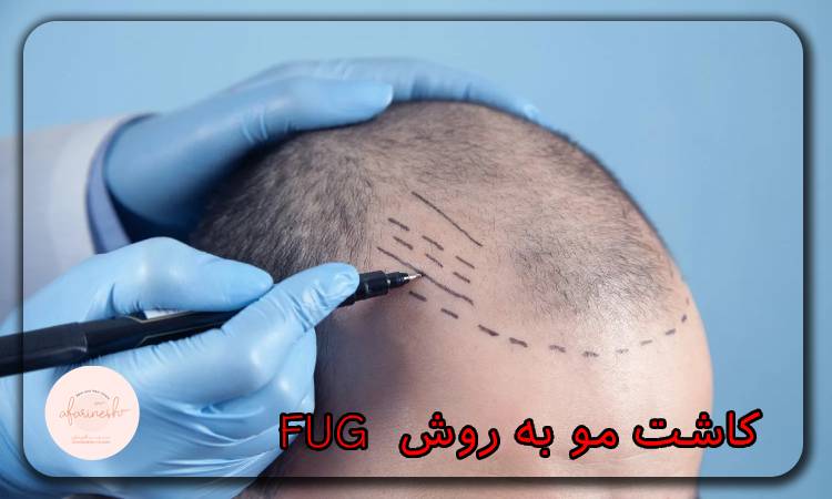 کاشت مو به روش FUG