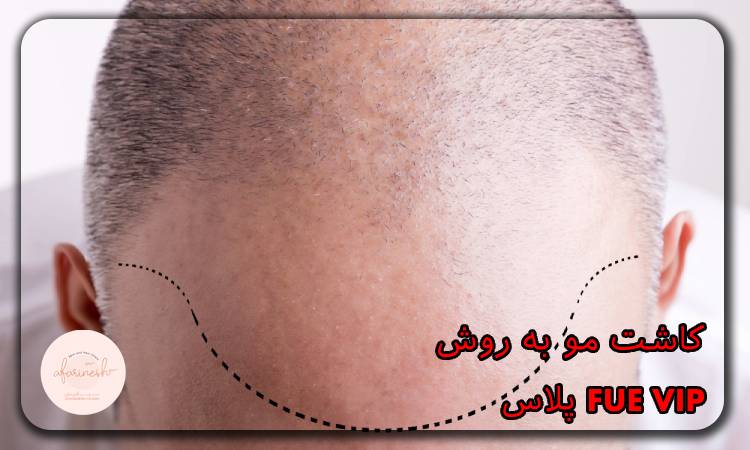 کاشت مو به روش fue vip پلاس