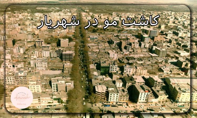 کاشت مو در شهریار
