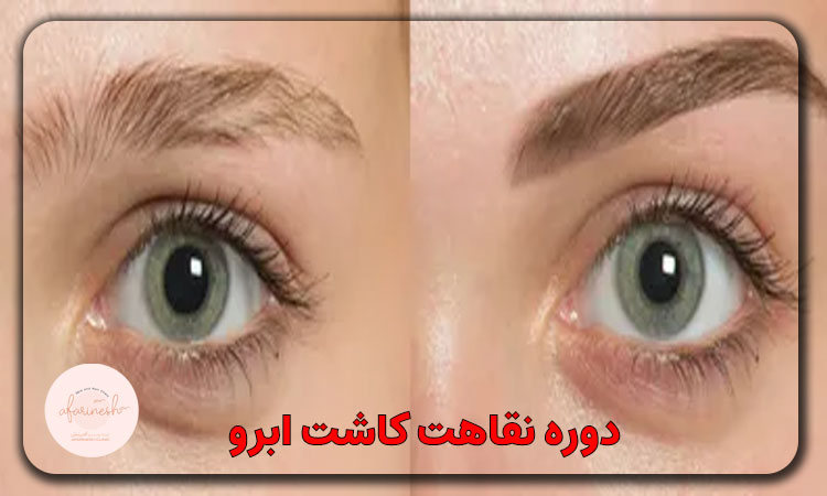 دوره نقاهت کاشت ابرو