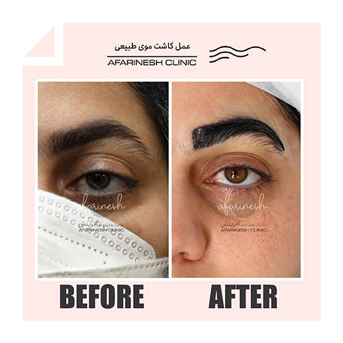 عکس کاشت ابرو بعد از چند ماه