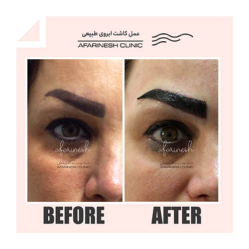 عکس کاشت ابرو بعد یک ماه