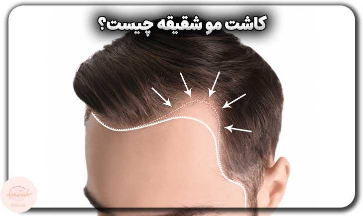 کاشت مو شقیقه چیست؟