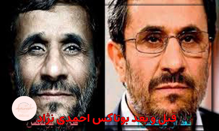 آیا احمدی نژاد بوتاکس کرده؟