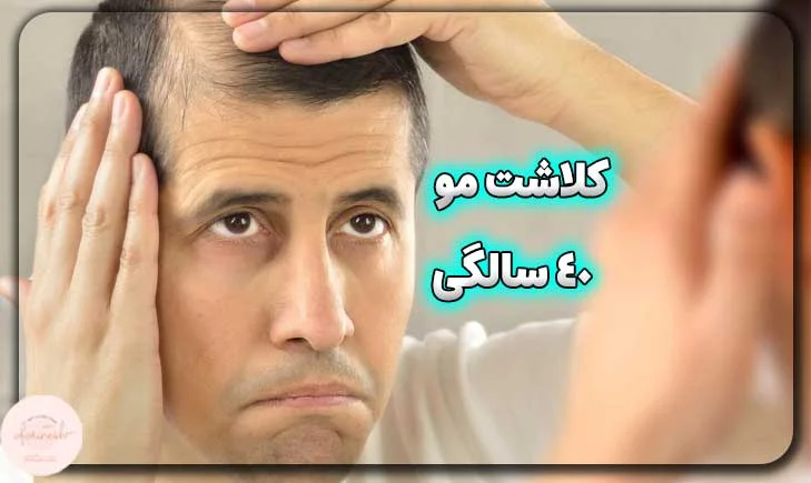 آیا کاشت مو در 40 سالگی امکانپذیر است؟