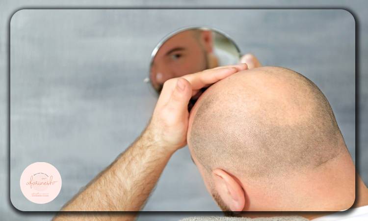 آیا افزایش روند رشد موهای کاشته شده ممکن است؟