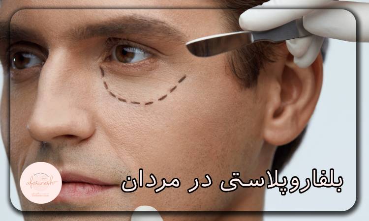 بلفاروپلاستی در مردان