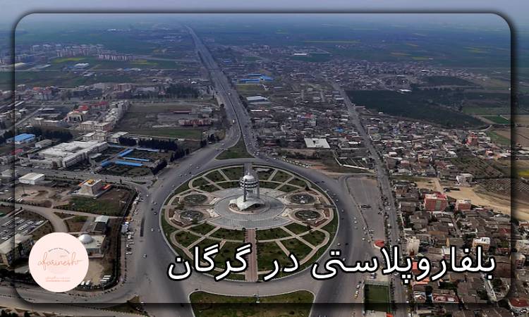 بلفاروپلاستی در گرگان