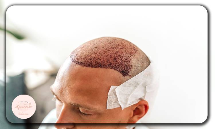 مراحل رشد موهای کاشته شده