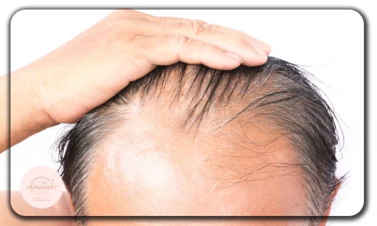 دلایل ریزش مو 40 سالگی