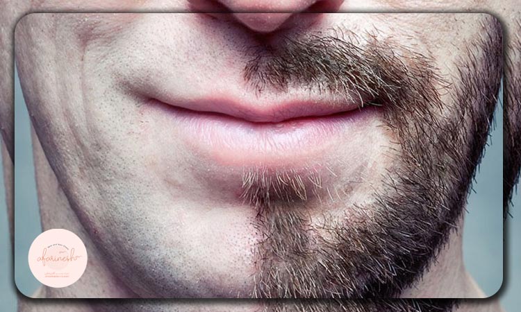 کاشت ریش به روش FUE