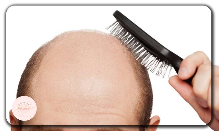 طاسی سر چیست و چه عللی دارد؟