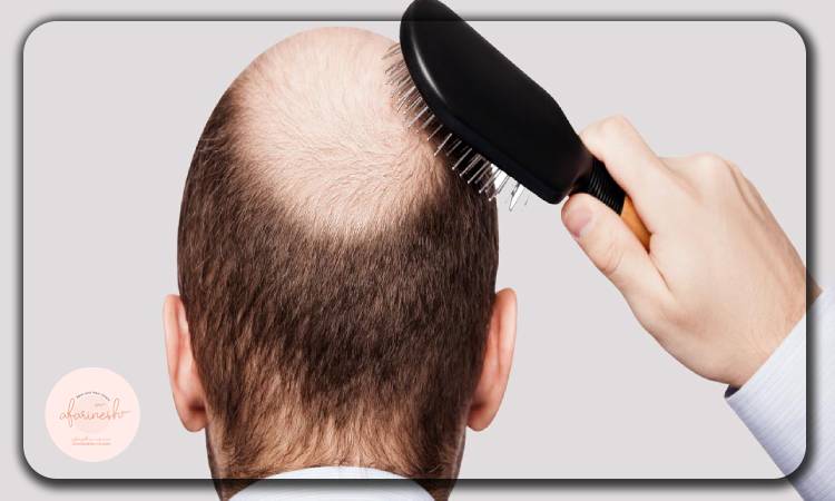 احکام شرعی ترمیم و کاشت مو
