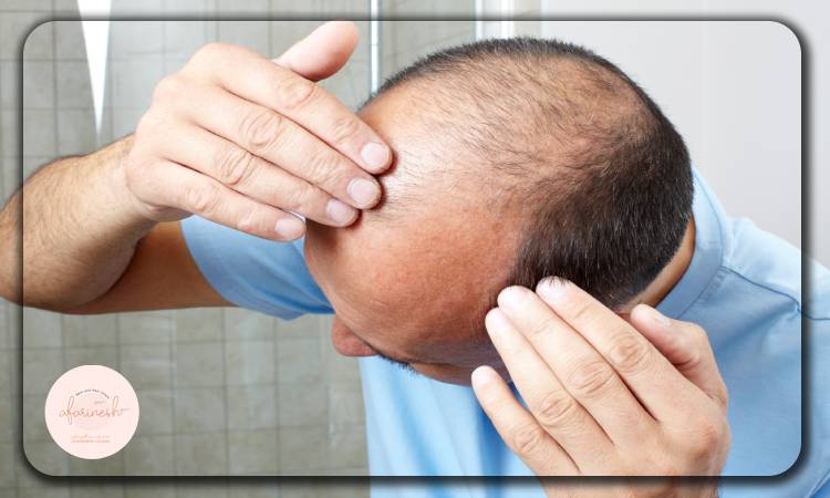 علت طاسی جلوی سر چیست؟