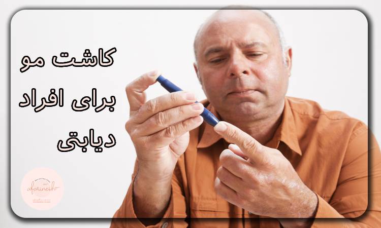 کاشت مو برای افراد دیابتی