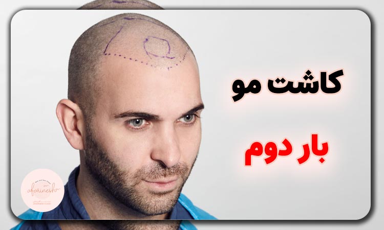 کاشت مو برای بار دوم
