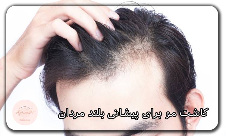 کاشت مو برای پیشانی بلند مردان