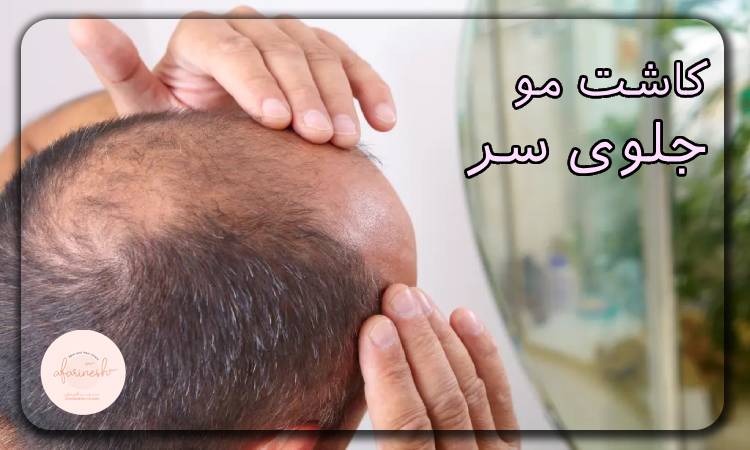 کاشت مو جلوی سر