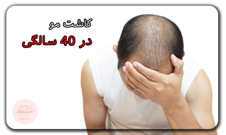 کاشت مو در ۴۰ سالگی