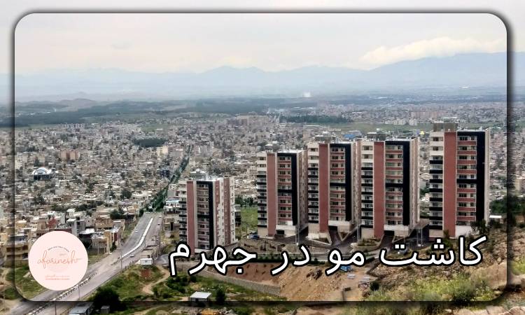 کاشت مو در جهرم
