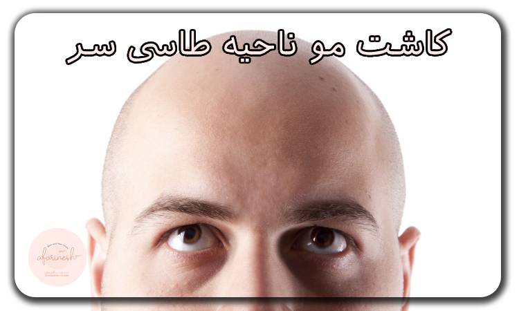 کاشت مو طاسی سر