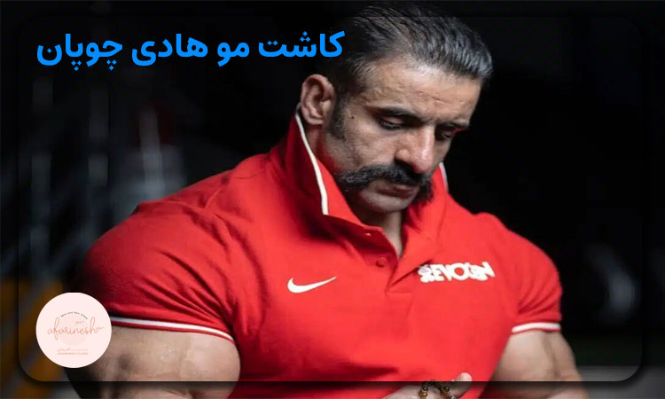 کاشت مو هادی چوپان
