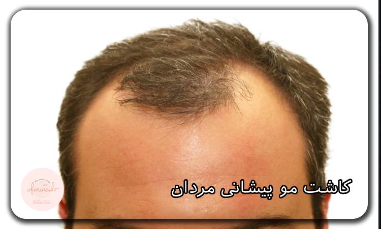 کاشت مو پیشانی مردان