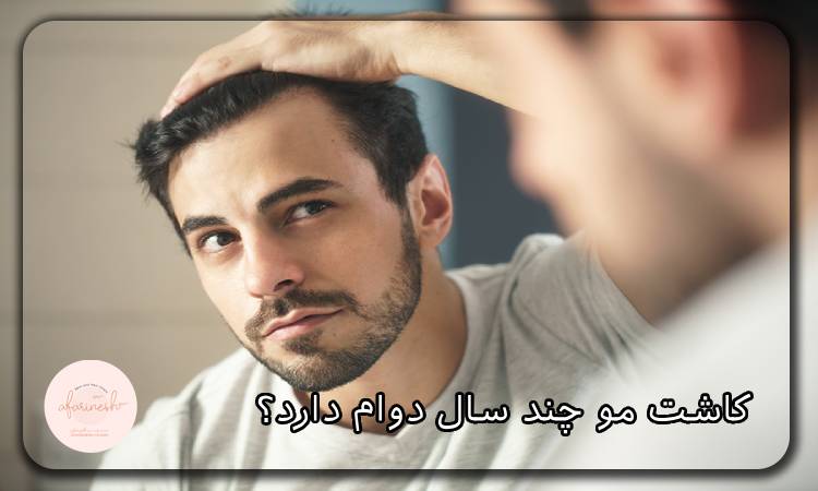 کاشت مو چند سال دوام دارد؟