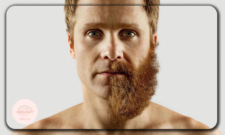 روش های کاشت ریش و قیمت های آن