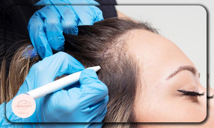 روش های کاشت مو برای خانم ها و هزینه آن ها