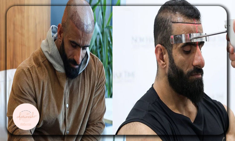 چرا کاشت مو برای هادی چوپان مهم است؟