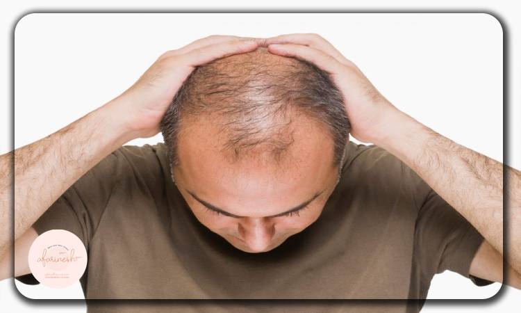 معایب و عوارض کاشت مو طاسی سر
