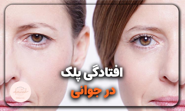 افتادگی پلک در جوانی