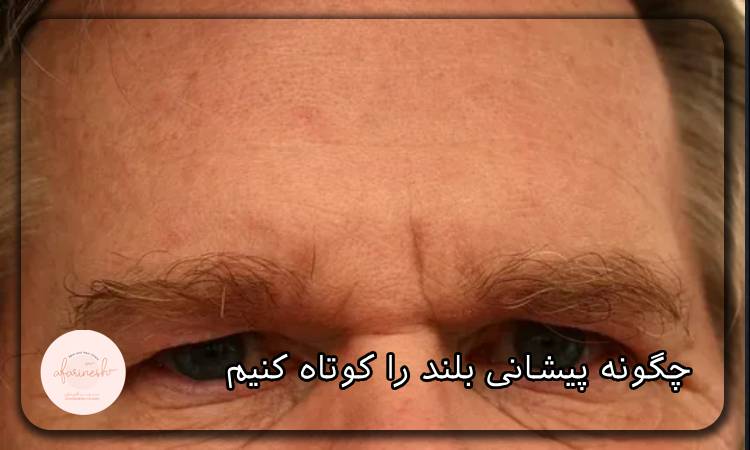 چگونه پیشانی بلند را کوتاه کنیم؟