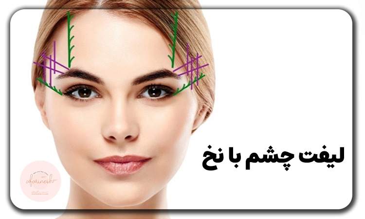 لیفت چشم با نخ
