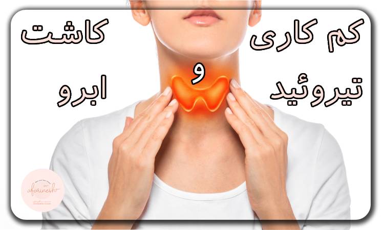 کم کاری تیروئید و کاشت ابرو