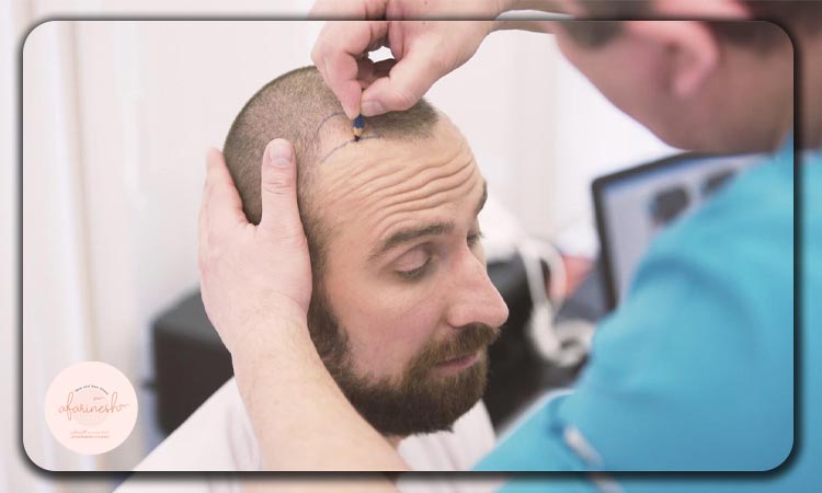 هزینه کاشت مو برای بار دوم