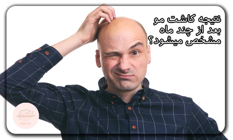 نتیجه کاشت مو بعد از چند ماه مشخص میشود