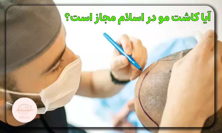 آیا کاشت مو در اسلام مجاز است؟