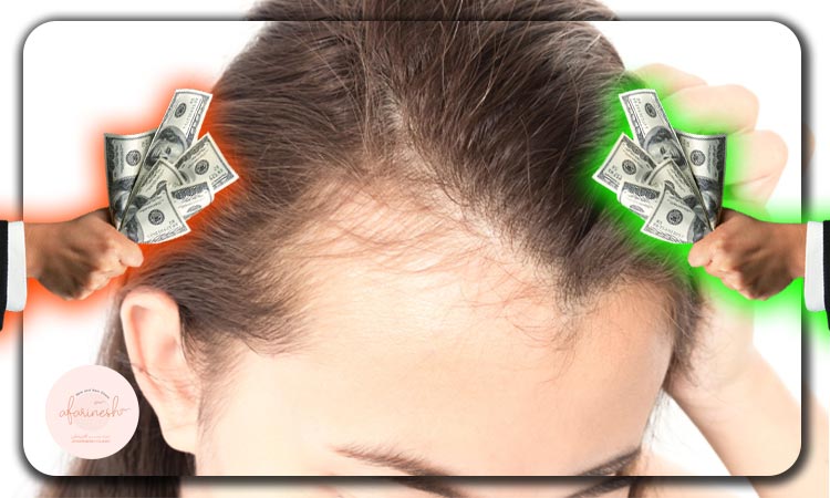 هزینه کاشت مو در پیشانی زنان