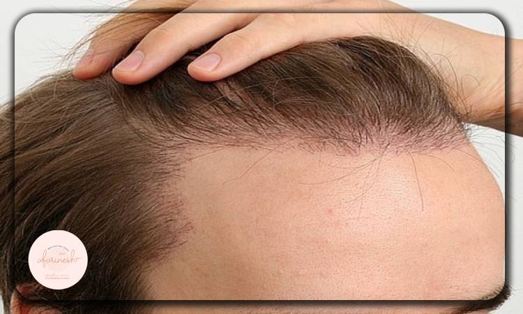 آیا کاشت مو روش مناسبی برای کوتاه کردن پیشانی است؟
