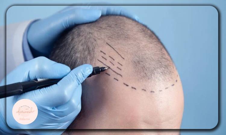 مزایای کوتاه کردن پیشانی
