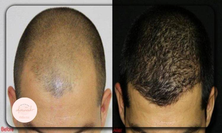 مزایای کوتاه کردن پیشانی