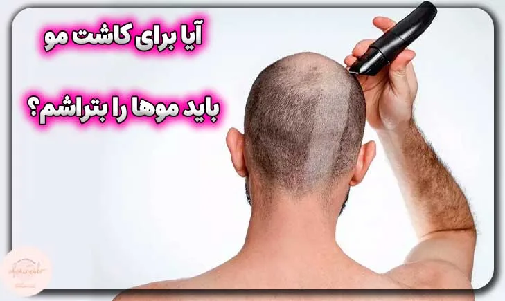 آیا برای کاشت مو باید موهایم را بتراشم؟