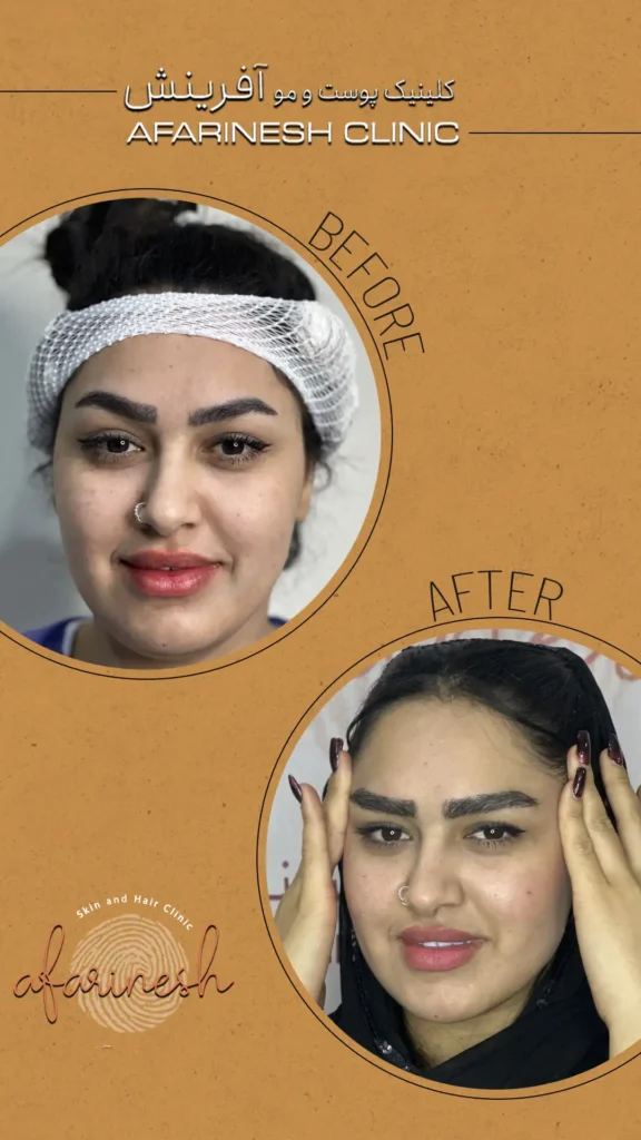 عکس کاشت ابرو بعد از یک ماه