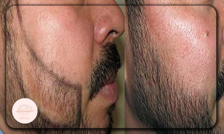 عکس بعد و قبل کاشت ریش