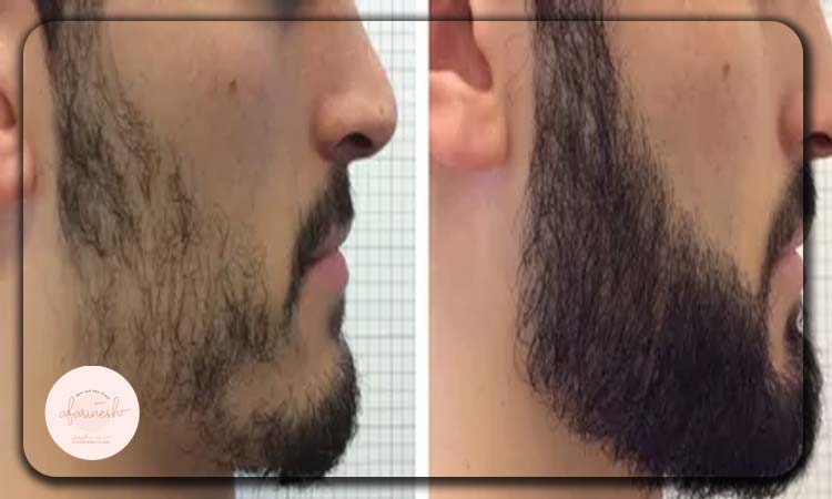 تصاویر بعد و قبل کاشت ریش