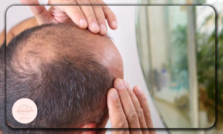 بهترین روش کاشت مو بدون بانک مو