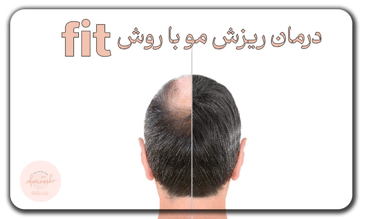 درمان ریزش مو با روش fit